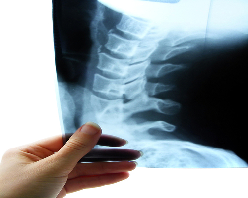 Costs of Recovery from a Spinal Cord Injury