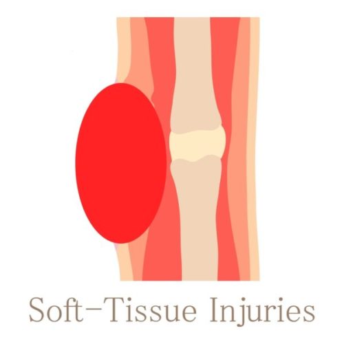 Soft Tissue Injuries Can Disrupt Your Life
