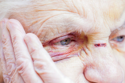 Three Nursing Home Injuries that are Often the Result of Neglect e1516080580708